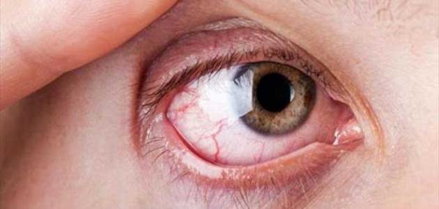 أعراض وأسباب جفاف العين وكيفية التعامل معها