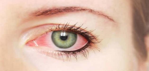 أسباب احمرار بياض العين وعلاجه في المنزل