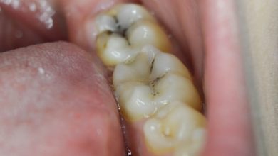ما السبب المحتمل لتسوس الأسنان