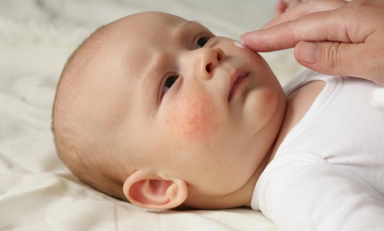 الأسباب الشائعة لحساسية الجلد عند الأطفال وكيفية التعامل معها بشكل صحيح