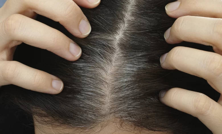 هل الإجهاد يسبب شيب الشعر؟